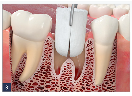 RegenerOss® Bone Graft Plug