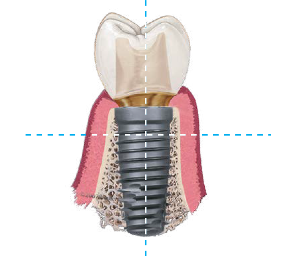 A dental implant and implant crown are designed to mimic the look, feel, and function of a natural tooth.