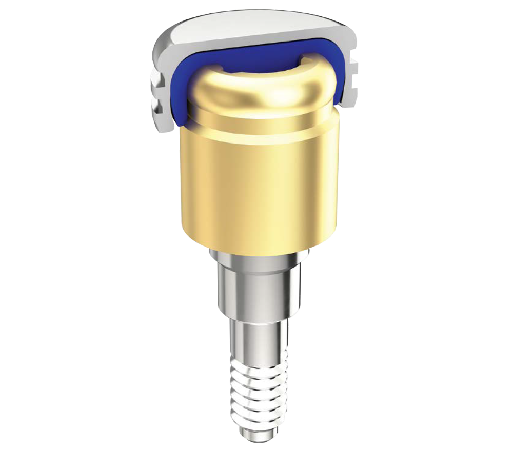 OverdenSURE® Removable Attachment System