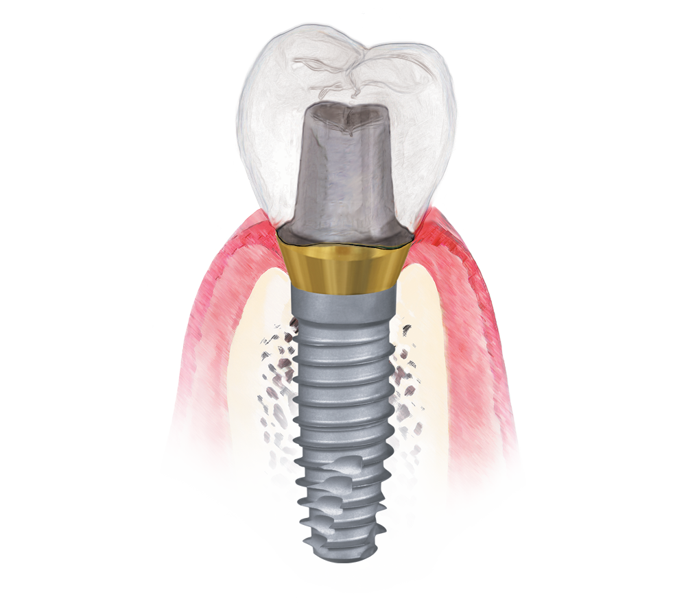 GingiHue Abutment
