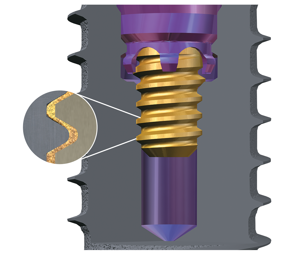 Implant/Abutments Clamping Force Image