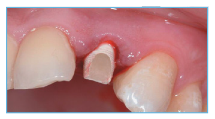 Fig. 3. The PreFormance Post was prepared intraorally to follow the gingival contours. 
