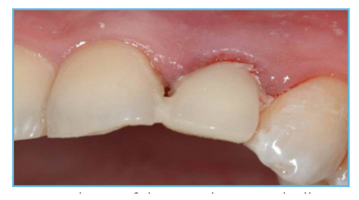 Fig. 4. The prefabricated crown shell was luted to the PreFormance Post.