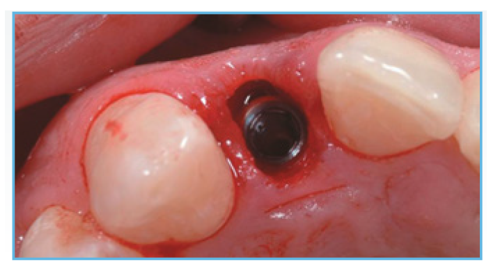 Fig. 1. NanoTite® Certain Implant in place. The bone was profiled around the interface.