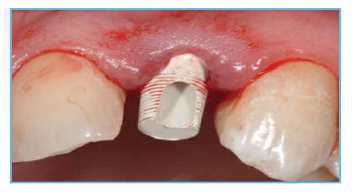 Fig.A PreFormance Post was seated into the implant Fig. 2. A PreFormance Post was seated into the implant.