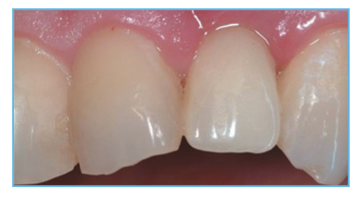 Fig. 5. The provisional restoration was fabricated, occlusal and interproximal contacts were checked, adjusted accordingly, and delivered to the patient.
